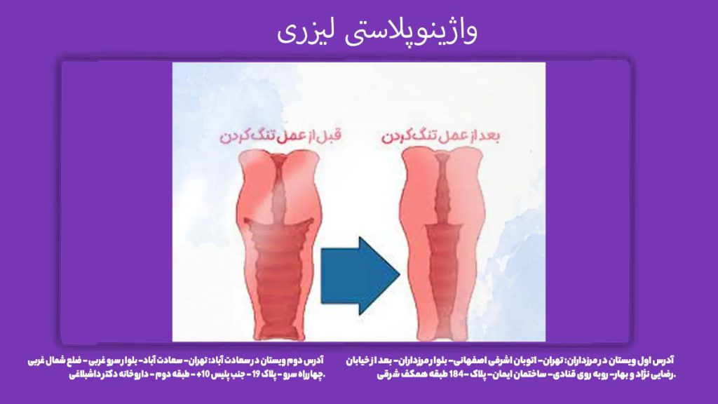 واژینوپلاستی لیزری جوانسازی واژن با لیزر