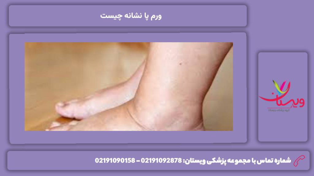 علت ورم پا ورم پا نشانه چیست