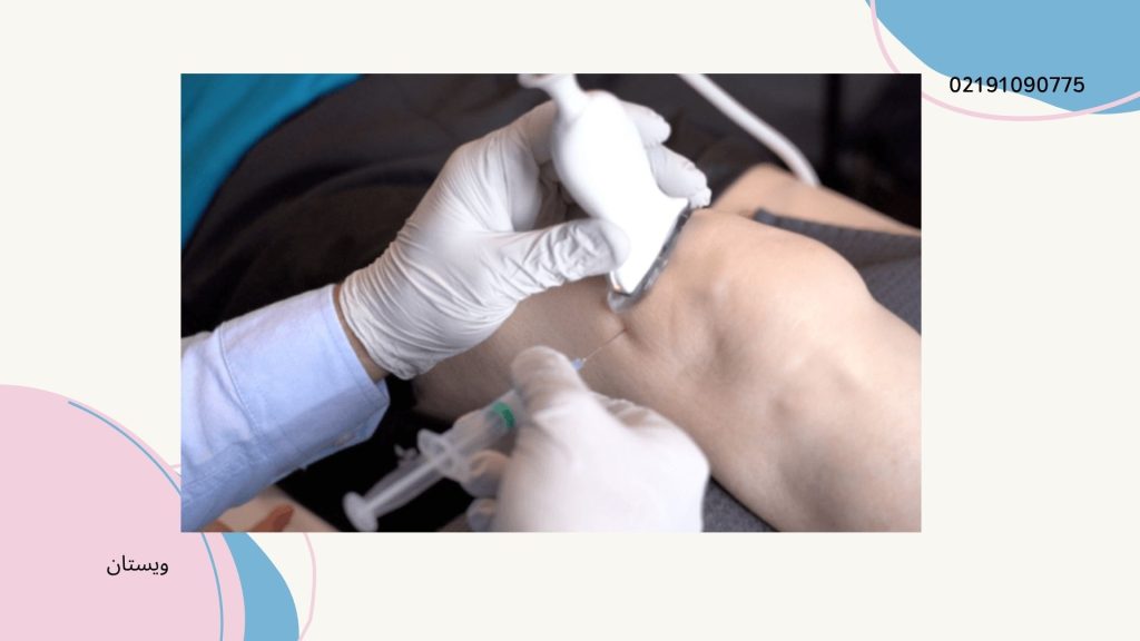 تزریق با بی حسی و کمی سوزش همراه است. تزریق ژل به زانو برای پارگی مینیسک یک نوع درمان غیر تهاجمی است.