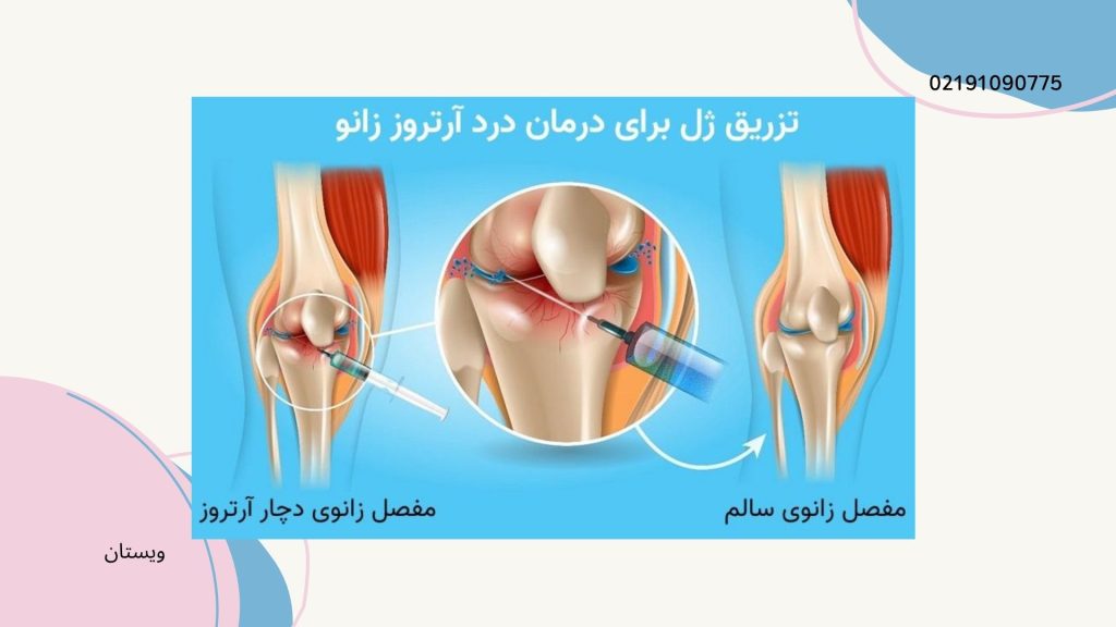 از بهترین درمان آرتروز زانو تزریق ژل به زانو است. تزریق ژل به زانو برای پارگی مینیسک ممکن است درد را تا 40 تا 70 درصد در 6 ماه کاهش دهد.